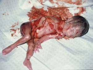 abortion_22_weeks01
